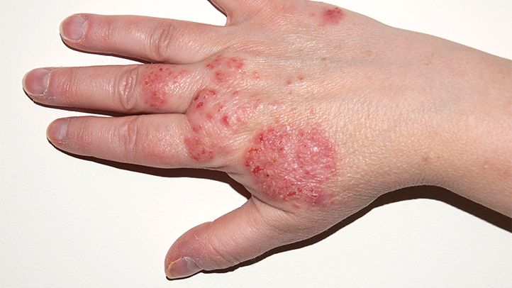 Homeopathic solutions for Skin Disorders