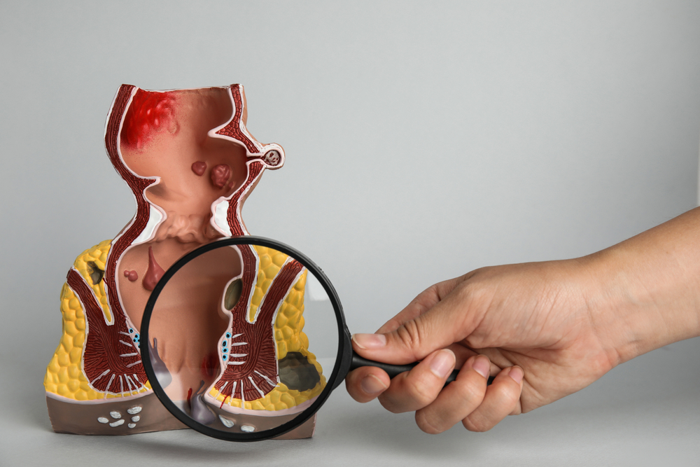 Homeopathic solutions for Gastro intestinal disorders