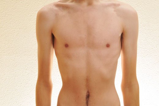 Homeopathic solutions for Anorexia Emaciation