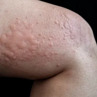 Homeopathic solutions for Skin Disorders