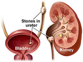 Homeopathic solutions for Kidney Stone Creatinine uric acid impariment